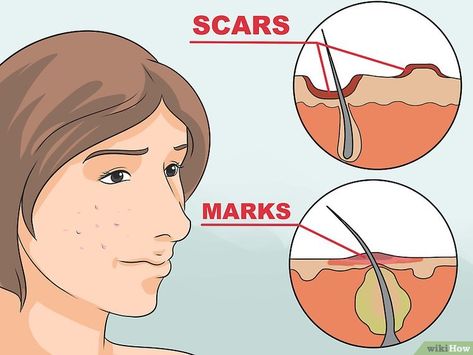 2 Easy Ways to Get Rid of Red Acne Marks (with Pictures) Red Acne Marks, How To Do Eyeshadow, Cystic Acne Remedies, Steaming Your Face, Dark Spots On Face, Natural Acne Remedies, Acne Scar Removal, Spots On Face, Pimple Marks