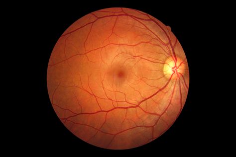 Recent studies have shown that brain disease can manifest itself in the retina of the eye Eye Anatomy, Human Tissue, Brain Diseases, Degenerative Disease, Kindle Publishing, Color Vision, Gene Therapy, Blood Vessels, Stem Cells