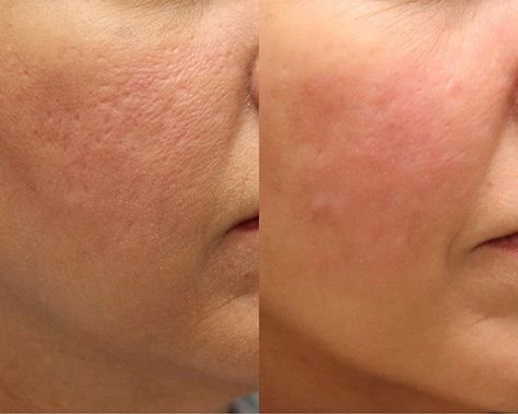 Microneedling Before And After, Microneedling Aesthetic, Laser & Ipl Hair Removal Devices, Skin Care Pictures, Acne Scarring, Eye Liner Tricks, Ipl Hair Removal, Dream Career, Acne Blemishes