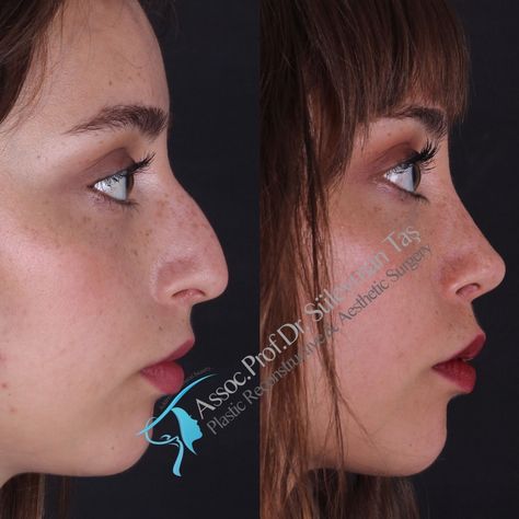 Closed & Atraumatic Technique in Rhinoplasty, Istanbul/Turkey. Assoc.Prof. Dr. Suleyman TAS. Before & After gallery for rhinoplasty (nose job). #makeupideas #makeup Nose Surgery Rhinoplasty, Rhinoplasty Nose Jobs, Rhinoplasty Before And After, Rhinoplasty Surgery, Best Plastic Surgeons, Job Inspiration, Pretty Nose, Nose Makeup, Perfect Nose