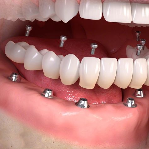 3D Printing: Dental company Straumann looks to get their teeth into 3D printing - https://3dprintingindustry.com/news/dental-company-straumann-looks-get-teeth-3d-printing-105895/?utm_source=Pinterest Dental Animation, Egg Substitutes, Oreo Pudding, Medical Animation, Oreo Brownies, Cheap Storage, Woodworking Magazine, Popular Woodworking, Fudge Brownies