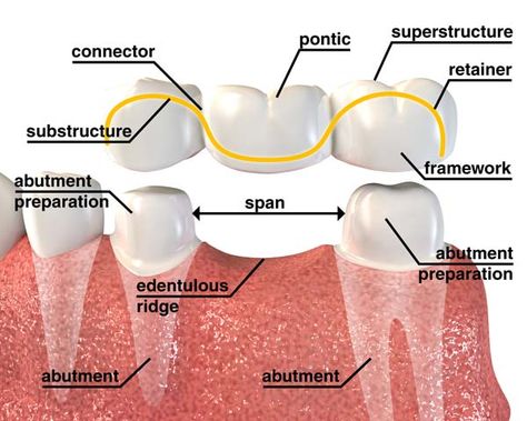 Fixed bridge #LakeWorth #Florida Dentist, health, Dr. Suarez Dental Bridge Cost, Dental Mouthguards, Dental World, Los Angeles Downtown, Dental Anatomy, Dental Fillings, Dental Design, Teeth Implants, Dental Bridge