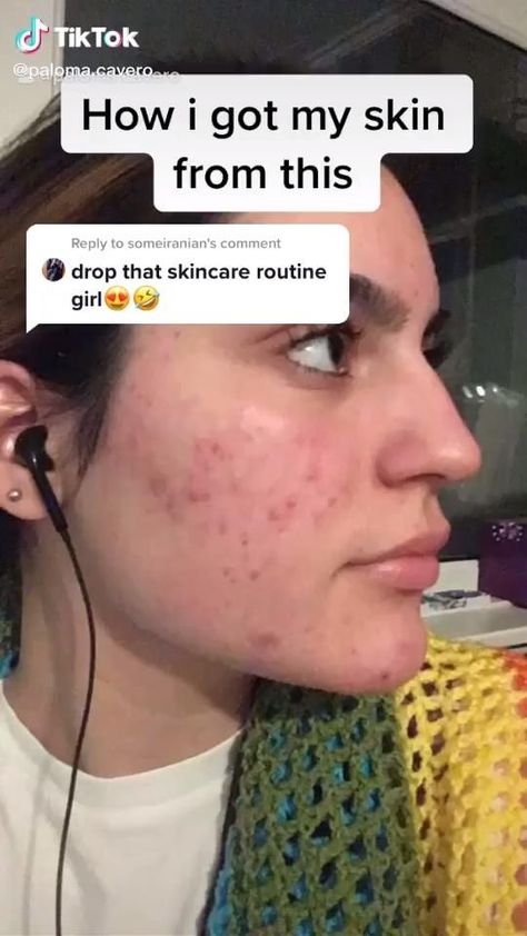 Haut Routine, Acne Overnight, Acne Removal, Acne Scar, Types Of Acne, Skin Care Tutorial, Beauty Tips For Glowing Skin, Hormonal Acne, Healthy Skin Tips