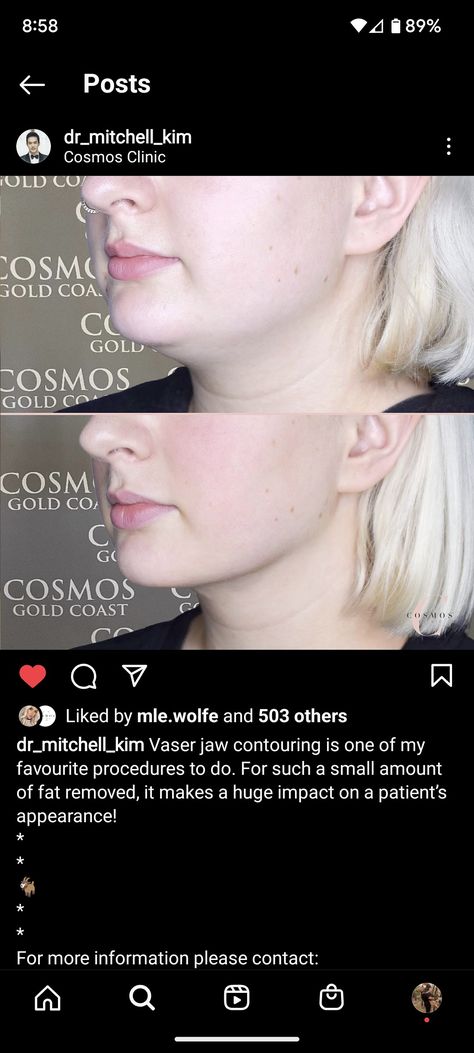 Vaser Lipo Before And After, Neck Lipo Before And After, Chin Lipo Before And After, Vaser Lipo, Lipo Before And After, Face Fillers, Body Details, Fat Transfer, 2023 Vision