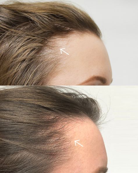 HD-PRP   Results shown after 6 weeks  PRP has become a mainstay for slowing hair loss and growing new hair for both men and women, but High Density (HD) PRP has become the new standard thanks to Dr. Welter and the pioneering research of the Regeneris team.   #photofacial #bostonlaser ⁠#botoxboston #fillersboston #lipfiller #medspa #wrinkles #neckwrinkles #hairlosswomen #hairlosstreatment #hairlosssolutions #hairloss Prp For Hair, Prp Facial, Prp Hair, Biotin Hair Growth, Fast Hair Growth, Biotin Hair, Skin Aesthetics, Fast Hair, Beautiful Gray Hair