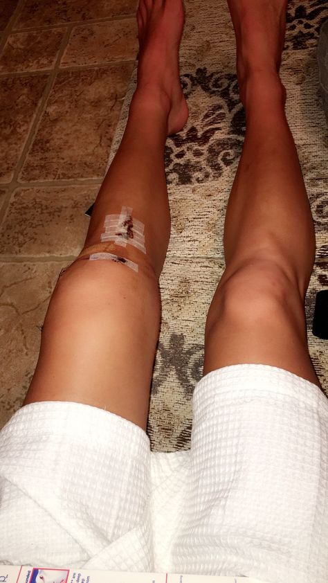 (9/3/17) Day 5 post ACL surgery Torn Acl Aesthetic, Post Acl Surgery, Acl Tear Recovery, Acl Surgery Recovery, Acl Recovery, Torn Acl, Acl Surgery, Acl Tear, Surgery Recovery