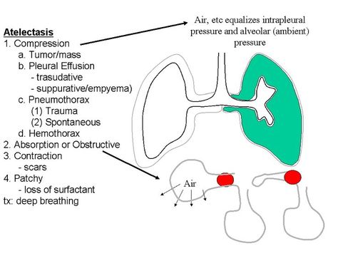 Atelectasis Nerdy Nurse, Pleural Effusion, Lung Conditions, Nursing Mnemonics, Nursing Student Tips, Pharmacology Nursing, Respiratory Therapy, Med Surg, Respiratory System