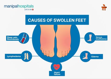 Here are some major swollen ankles causes 1. Edema: Fluid retention due to numerous factors like standing for long periods, pregnancy, or underlying health conditions like heart disease.  2. Venous insufficiency: Impaired blood flow from the legs back to the heart, often due to damaged valves in veins.  3. Lymphedema: Blockage or damage to the lymphatic system, leading to fluid buildup in tissues, commonly in arms or legs.  4. Deep vein thrombosis (DVT): Blood clot formation in deep veins of the legs, causing swelling, pain, and potentially life-threatening complications.  Consult our cardiologist if you are having symptoms related to the above swollen feet causes. Swollen Feet Causes, Leg Swelling, Pediatric Surgery, Interventional Radiology, Vein Thrombosis, Medical Oncology, Swollen Ankles, Vascular Surgery, Venous Insufficiency