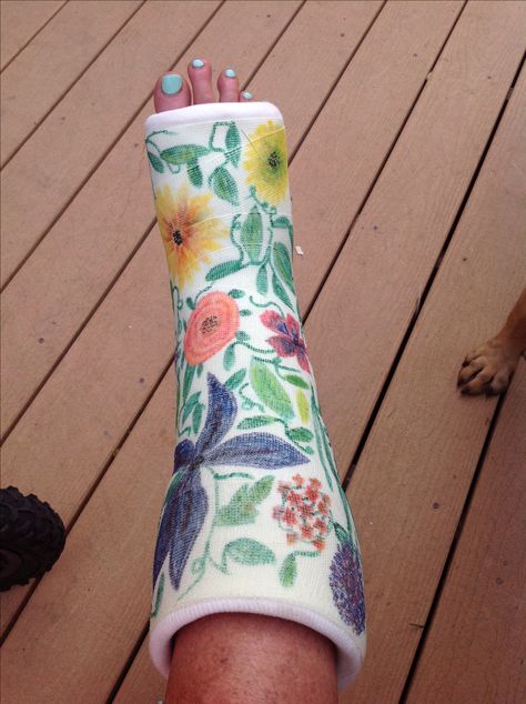 Arm Cast Decorating Ideas, Broken Arm Cast, Cast Decoration, Long Leg Cast, Arm Cast, Broken Ankle, Leg Cast, Cast Art, Broken Arm