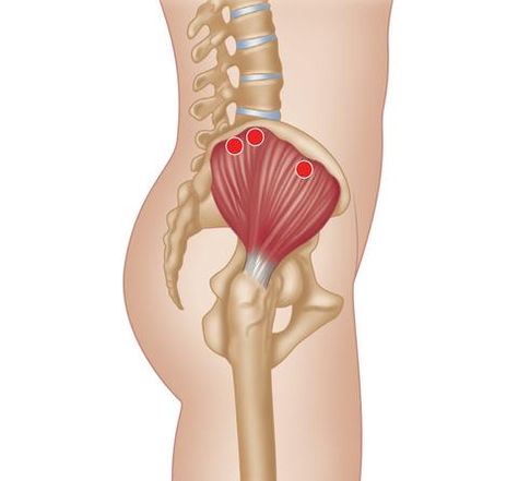 Treating Gluteus Medius Trigger Points - Stretching – Niel Asher Healthcare Hip Injury, Melissa Bender, Trigger Point Release, Glute Medius, Gluteus Maximus, Manual Therapy, Biceps Brachii, Referred Pain, Hip Injuries