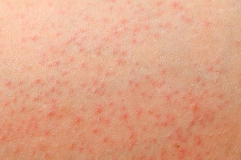 Red Rashes On Skin, Skin Rashes Pictures Types Of, Skin Rashes Pictures, Rash On Back, Allergic Reaction Rash, Types Of Skin Rashes, Leg Rash, Itchy Skin Rash, Rash On Face