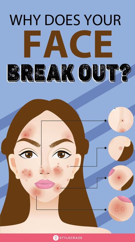 Break Outs On Face, Why Am I Breaking Out Chart, Breakouts On Face Meaning, Breaking Out On Face Meaning, Why Is My Face Breaking Out, How To Prevent Breakouts, Pimples Between Eyebrows, What Breakouts Mean Face Mapping, What Your Pimples Mean