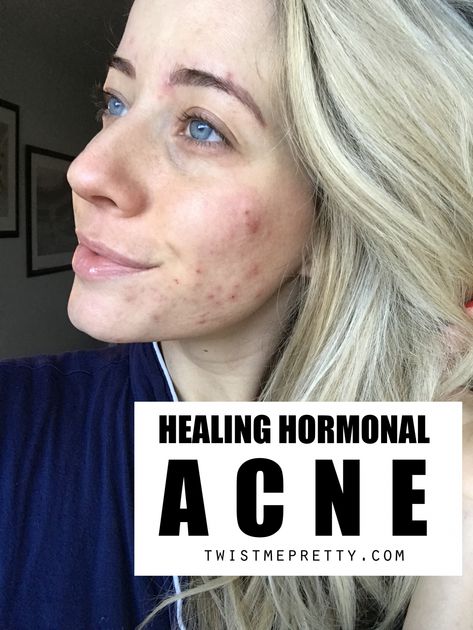 How To Clear Up Hormonal Acne + My Journey - Twist Me Pretty Cystic Hormonal Acne, How To Help Hormonal Acne, How To Clear Up Acne, Hormone Acne, Hormonal Acne Skincare Routine, Clear Hormonal Acne, Postpartum Acne, Cheek Acne, Medical Remedies