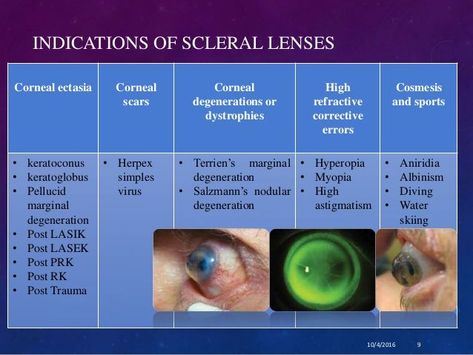 Scleral Contact Lenses, Scleral Lenses, Opthalmic Technician, High Diving, Contact Lenses, You Call, Medicine, Lenses, Quick Saves