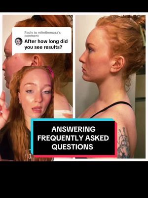 Replying to @Sasstoid How to fix your neck hump #neckhump #neckhumpf... | tech neck | TikTok Exercise Tiktok, Neck Exercise, Neck Hump, Tech Neck, Fix You, Upper Body, Fix It