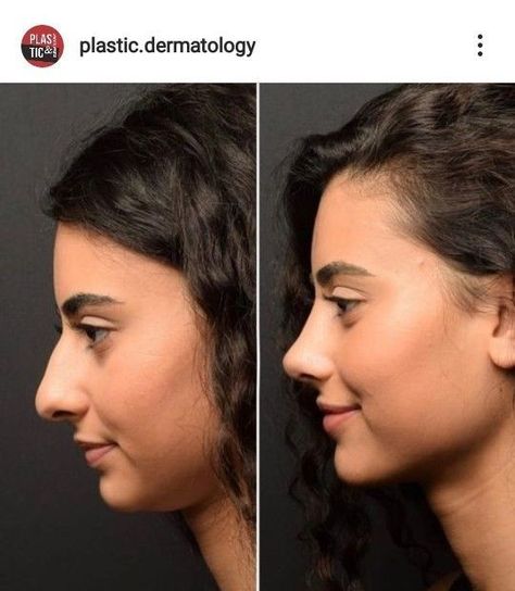 #plasticsurgery #plasticsurgerygonewrong #beforeafter #celebritiesbeforeafter #hollywoodstars #bignosesurgery #surgery #facesurgery #vlinesurgery #koreanplasticsurgery #kpopplasticsurgery #nosejob #jawreductionsurgery #eyesurgery #cheekfillers #rhinoplasty #facelift #plasticsurgeryfails #expensiveplasticsurgery Refined Tip Rhinoplasty, Face Surgery Before And After, Chin Augmentation Before And After, Jaw Surgery Before And After, Rhinoplasty Before After, Nose Job Before And After, Nose Plastic Surgery, Face Plastic Surgery, Nose Surgery Rhinoplasty