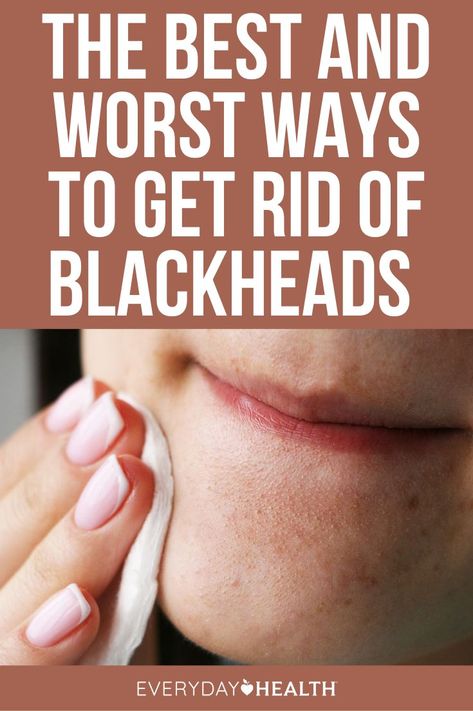 Hint: Don’t pop them. Instead, stock your vanity with products that contain acne-fighting ingredients. How To Prevent Blackheads, Remedies For Inflammation, Natural Remedies For Sore Throat, Oil Free Acne Wash, Natural Remedies For Cold, All Natural Home, Natural Remedies For Cough, For Sore Throat, Remedies For Cough