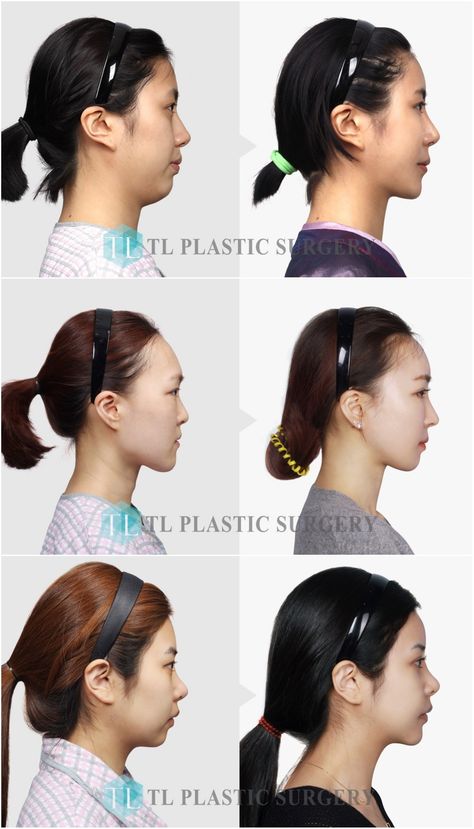 Forehead Reduction, Small Forehead, Reduction Surgery, Fat Transfer, Facial Plastic Surgery, Forehead Wrinkles, Facial Plastic, Cosmetic Procedures, Plastic Surgeon