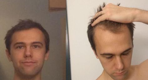 Got a pretty big forehead and receding hairline. Is a buzzcut my only option?- ThorGift.com - If you like it please buy some from ThorGift.com Men's Hairstyle, Receding Hairline, Big Forehead, Mens Hairstyles, Hairstyles, Hair Styles, Hair, Quick Saves