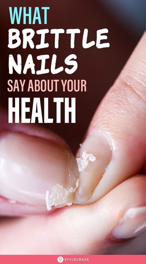 What Brittle Nails Say About Your Health: Brittleness of the nails refers to a condition where nails easily crack, chip, split or even peel off. It’s important to understand that sometimes brittle nails aren’t just something silly, it could be a sign of something serious too. #nails #nailcare #nailcaretips Cracked Nails, Peeling Nails, Nail Care Tips, Brittle Nails, Creative Lifestyle, New Nail Art, Nail Fungus, Strong Nails, Nail Health