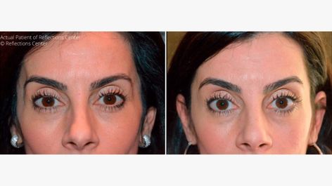 Temple Filler Before And After, Temple Filler, Sculptra Aesthetic, Reduce Water Retention, Surgical Procedures, Facial Fillers, Injectables Fillers, Facial Plastic Surgery, Facial Plastic