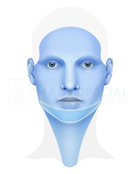 Genioplasty or chin surgery at Instituto Maxilofacial Post Surgery Care Package, Chin Surgery, Nose Aesthetic, Facial Aesthetic, Surgery Care Package, Orthognathic Surgery, Aesthetic Surgery, Jaw Surgery, Nose Surgery