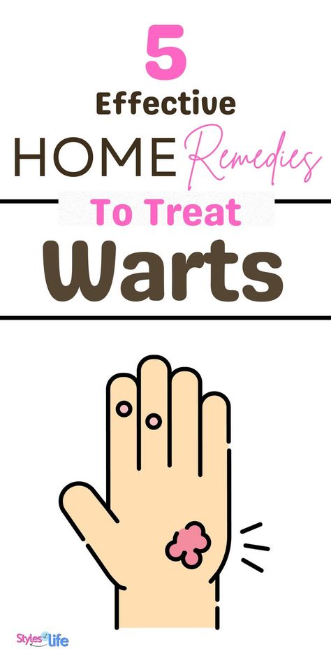 Home Remedies For Warts Home Remedy For Warts, Wart Remedies, Flat Warts, Types Of Warts, Warts On Face, Home Remedies For Warts, Warts Remedy, Get Rid Of Warts, Band Aid