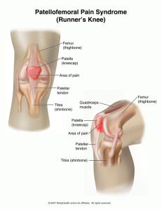 Runner's Knee Patella Femoral Syndrome, Patellofemoral Pain Syndrome, Iliotibial Band, Runners Knee, Kt Tape, Knee Cap, Muscle Imbalance, Psoas Muscle, It Band