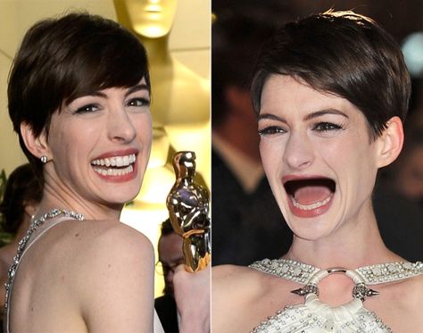 Hollywood White Teeth, Celebrity Teeth Before And After, Hollywood Smile Teeth, Angelina Jolie Smile Teeth, Celebrity Teeth, Dental Offices, Posting Ideas, Wisdom Teeth Meme, Hilarious Photos