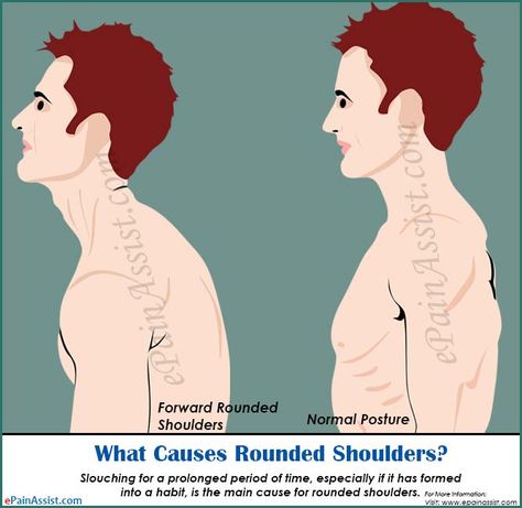 Round Shoulders, Neck Hump, Pilates Stretches, Easy Exercise, Rounded Shoulders, Pelvic Tilt, Body Sweat, Sinus Infection, City Hunter