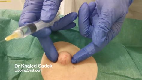 Plum sized back cyst. Dr Khaled Sadek. LipomaCyst.com Cysts Popping Videos, Big Zits, Squeezing Blackheads, Lipoma Removal, Pimple Popper Tool, Big Pimple, Zits Popping, Slim Fast, Health Trends