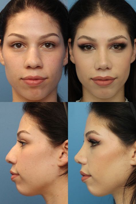 Thick Nose Rhinoplasty, Ethnic Rhinoplasty, Rhinoplasty Surgery, Rhinoplasty Before And After, Celebrity Plastic Surgery, Thick Skin, Before After Photo, Nose Job, Plastic Surgery