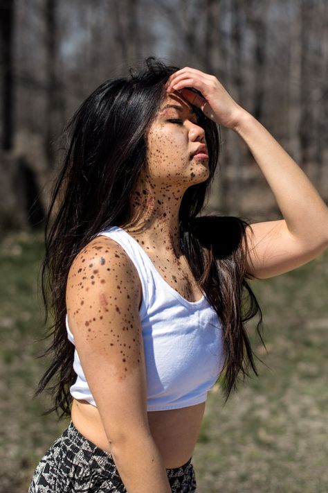 Really inspiring article about overcoming the struggle of being different-This Is What It's Like to Live With Birth Marks Covering Your Face and Body Cool Birth Marks, Different Beauty People, Birthmarks On Face, Face Birthmark, Birthmark On Face, Beauty Marks On Face, Birth Marks, Skin Positivity, Beauty Marks