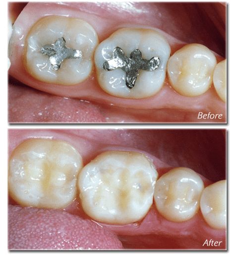 amalgam mercury filling removal dentist Cosmetic Dentistry Veneers, Amalgam Fillings, Tooth Filling, Health Aesthetic, Dental Photography, Dental Fillings, Aesthetic Dentistry, Dental Design, Dental Marketing