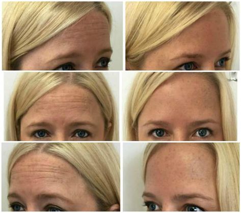 Botox Results, Facial Esthetics, Botox Before And After, Frown Lines, Get Rid Of Wrinkles, Photoshop Filters, Botox Injections, Photoshop Effects, Med Spa