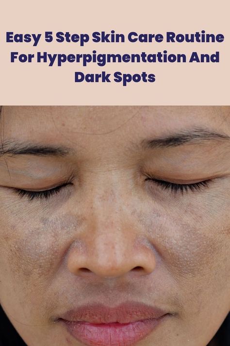 Treating hyperpigmentation became this easy with these 5 skin care steps. Here's how!
#pigmentation #darkspot #skincareroutine #unevenskintone Dark Patches On Face, Skin Care Hyperpigmentation, Skin Hyperpigmentation, Treating Hyperpigmentation, Oily Skin Acne, Face Routine, Dark Spots On Face, Brown Spots On Face, Spots On Face