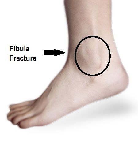 Broken Fibula, Fractured Ankle, Avulsion Fracture, Fracture Healing, Ankle Fracture, Muscle Testing, Therapy Exercises, Physical Therapy Exercises, Health Heal