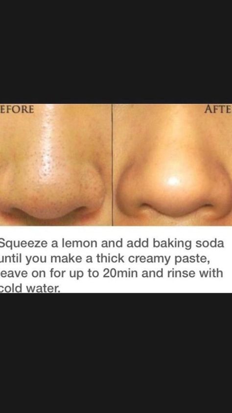 Blackhead Remover Diy, Face Mask For Blackheads, Blackhead Mask, Honey Face Mask, Honey Face, Healthy Fruit, Cold Sores Remedies, Natural Sleep Remedies, Get Rid Of Blackheads