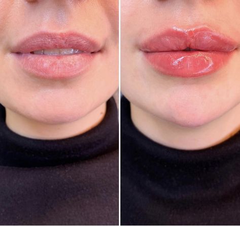 Hydra Gloss Lips, Bb Lips, Lips Inspiration, Botox Lips, Cheek Fillers, Cosmetic Injectables, Facial Aesthetics, Lip Filler, Celebrity Plastic Surgery