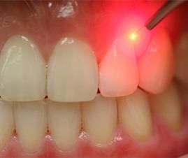 Laser Therapy Dental Laser, Gum Surgery, Preventive Dentistry, Laser Dentistry, Laser Teeth Whitening, Dental Facts, Restorative Dentistry, Dental Crowns, Dental Procedures