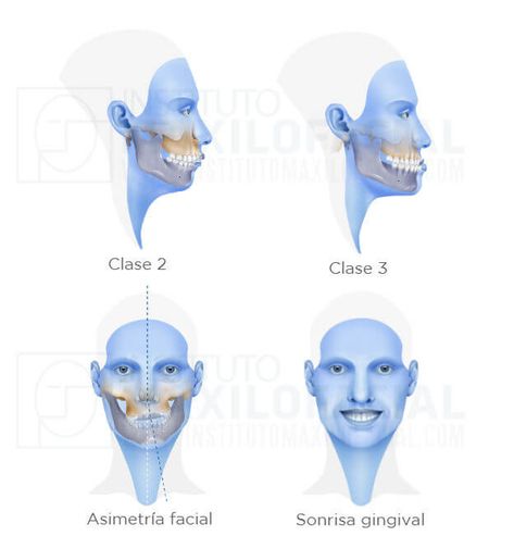 Orthognathic Surgery - Instituto Maxilofacial Orthognathic Surgery, Types Of Facials, General Anaesthesia, Jaw Bone, The Patient, Post Surgery, After Surgery, Teaching Activities, Facial Features