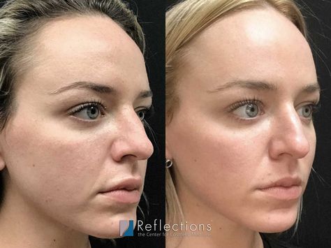 Fraxel Re:Store Dual Laser Resurfacing Near Me NJ | Reviews Cost Fraxel Before And After, Removing Hyperpigmentation, Laser Skin Resurfacing, Fractional Laser, Laser Resurfacing, Acne Scarring, Skin Resurfacing, Laser Skin, Scarring