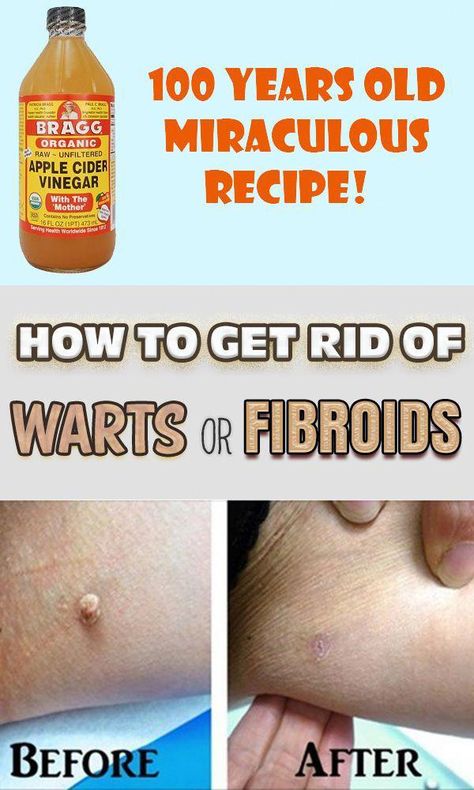 Warts On Hands, Apple Cider Vinegar Recipes, Warts On Face, Remove Warts, Unfiltered Apple Cider Vinegar, Get Rid Of Warts, Skin Tags, Natural Cold Remedies, Natural Cough Remedies