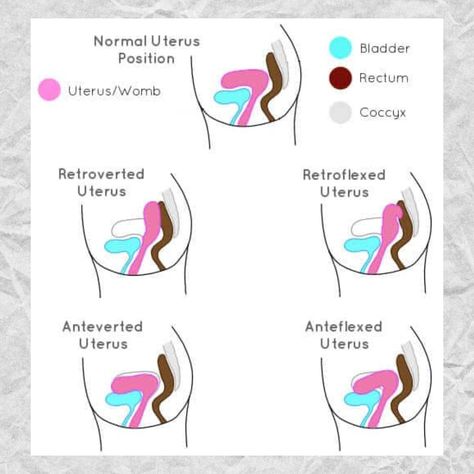 The position of the uterus and cervix can indeed influence the level of pain experienced during an intrauterine device (IUD) insertion. Here's how: Tilted Uterus: Some people have a uterus that tilts backward (retroverted uterus) or forward (anteverted uterus) instead of the typical straight up-and-down position. A retroverted uterus can sometimes make it slightly more challenging for the healthcare provider to navigate during insertion, potentially causing more pain. Conversely, an antevert... Tilted Uterus, Retroverted Uterus, Iud Insertion, Mucus Plug, Local Anesthesia, Intrauterine Device, Cervical Mucus, Medical Student Study, Pelvic Pain