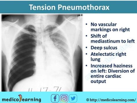 Chest X-ray interpretation Chest X Ray, Chest Xray, Medical Radiography, Medical Mnemonics, Radiology Imaging, Medical Pictures, Radiology Technologist, Pulmonology, Respiratory Care