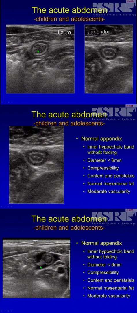 Ultrasound in pediatric abdomen emergency Ultrasound Abdomen Boards, Appendix Ultrasound, Pediatric Sonography, Pediatric Ultrasound, Sonography Humor, Ultrasound Humor, Abdomen Ultrasound, Diagnostic Medical Sonography Student, Gender Reveal Ultrasound