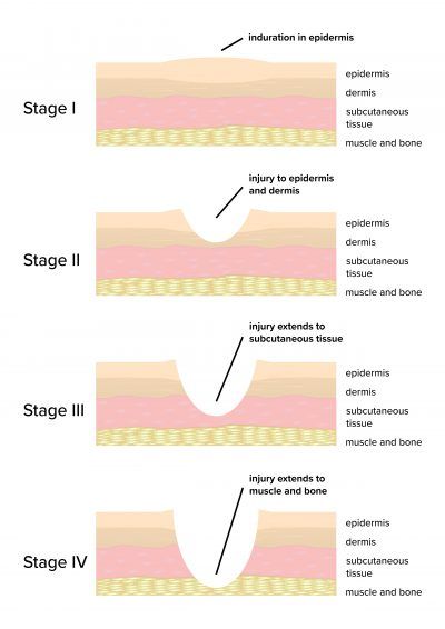 Ostomy Nursing Wound Care, Wound Dressing Chart, Senior Year Tips, Wound Healing Nursing, Nurses Life, Wound Care Nursing, Wound Care Dressings, Nursing School Scholarships, Guiding Principles