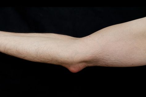 The olecranon bursa is the top part of the ulna bone in the lower arm, that forms the bony area at the back of the elbow. This is the area that supports the arm when elbows are leaned on a table. A bursa is a fluid filled sac that provides cushioning and lubrication at a joint. There are several bursae in the body, including one over the elbow joint which decreases the friction between the bones and overlying skin. Bursitis Elbow, Bursitis Knee, Medical Symptoms, Bursitis Hip, Elbow Pain, Graves Disease, Brain Surgery, Patient Education, Rotator Cuff