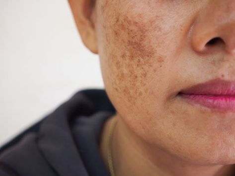 Is melasma the same as hyperpigmentation? Both of these terms are frequently used to describe skin conditions that result in dark patches of the skin, especially on the face. If you have dark patches on your skin that are bothersome, contact Buckhead Dermatology to schedule your appointment with our Atlanta-based, board-certified dermatologist today. Is melasma the same as hyperpigmentation? Find out more via our blog! Post Inflammatory Hyperpigmentation, Acne Overnight, Natural Acne Remedies, Dark Spots On Skin, Aesthetic Clinic, Skin Specialist, Skin Resurfacing, Laser Therapy, Skin Disorders