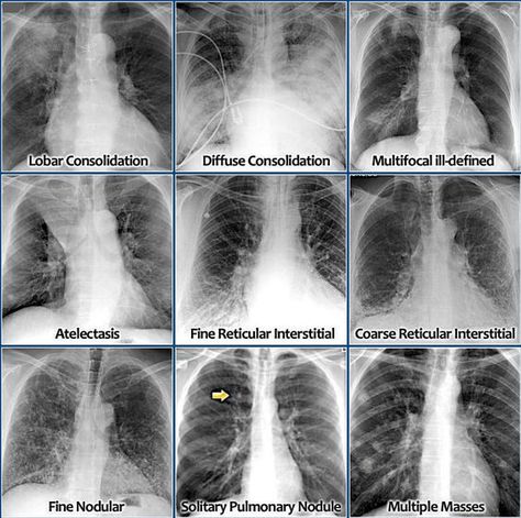 MediaOne on Twitter: "How to identify and differentiate lung diseases from chest x-ray.. https://t.co/bpfSSMXpKk" / Twitter Radiology Student, Radiology Imaging, Family Nurse Practitioner, Medical Student Study, Pulmonology, Respiratory Care, Critical Care Nursing, Respiratory Therapy, Medical School Studying